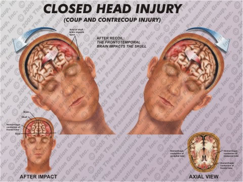Lessons about traumatic brain injury